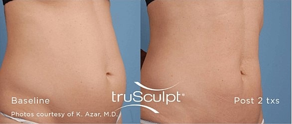 What is the Best System for Non-Surgical Body Contouring?