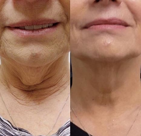 Can I Reduce My Double Chin Without Surgery?