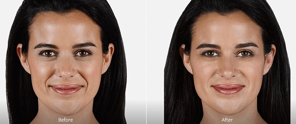 What Is The Difference Between Botox And Fillers?