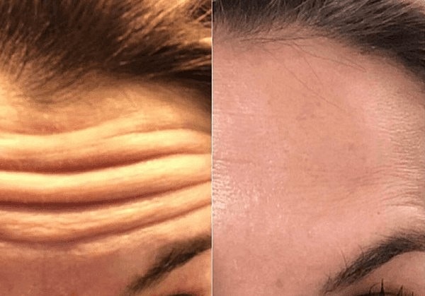 Does Botox® Last Forever?