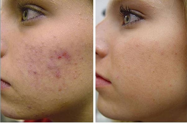 How Can I Enhance My Microneedling Results?