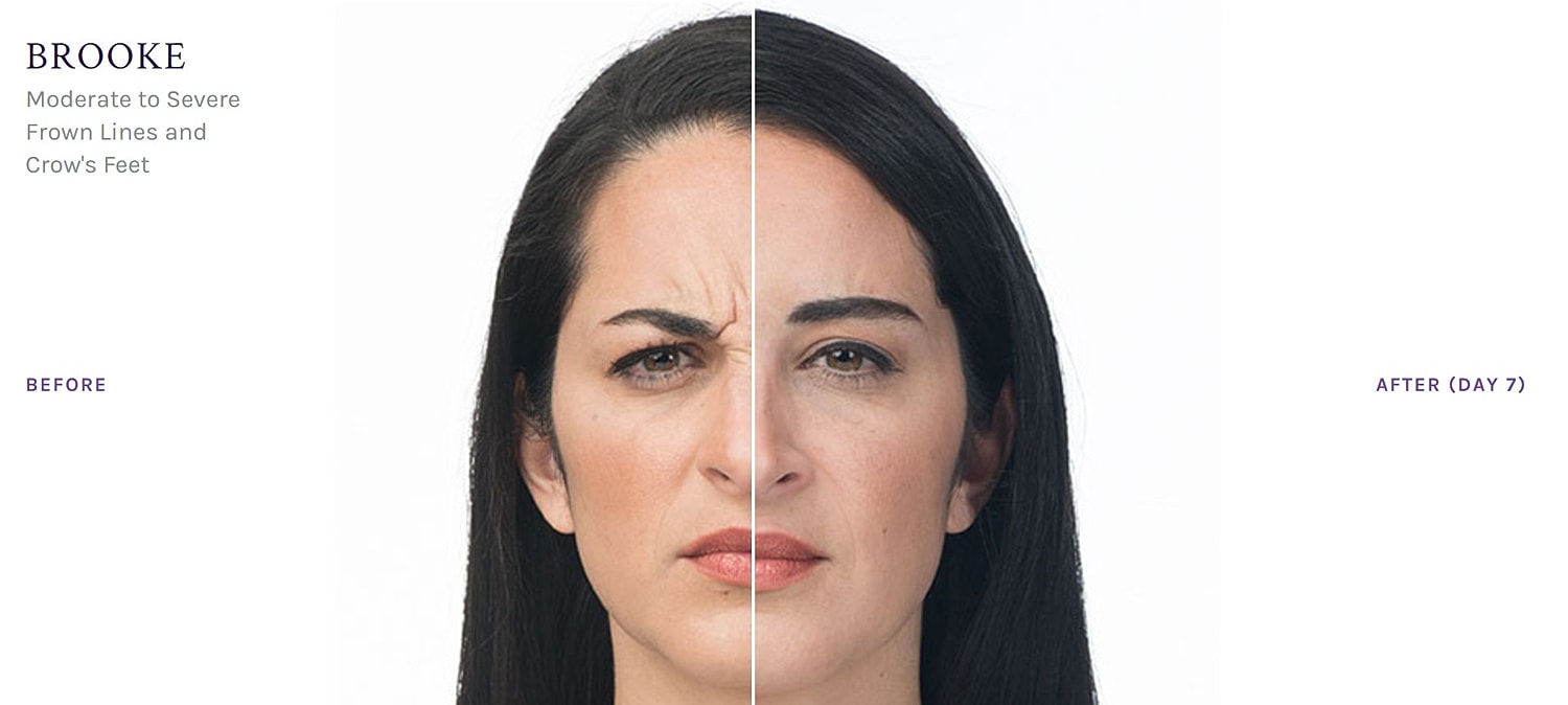 How Much Does Botox Cost?