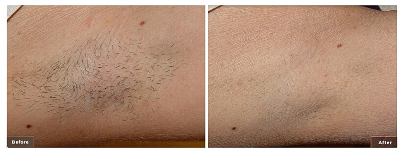 On What Areas of the Body Can Laser Hair Removal Be Performed?