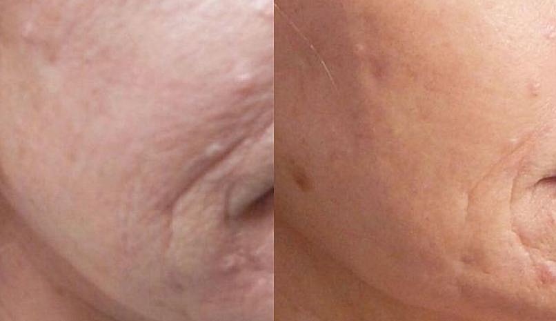 What Are the Benefits of Microneedling with PRP?