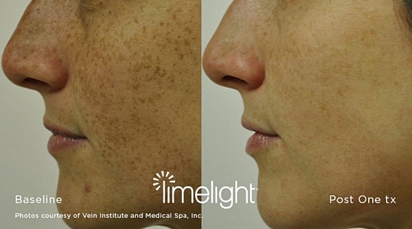 Before and after skin treatment comparison image.