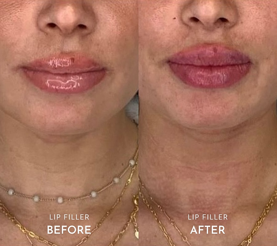Lip filler before and after comparison image