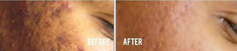 close up patient acne scars before and after