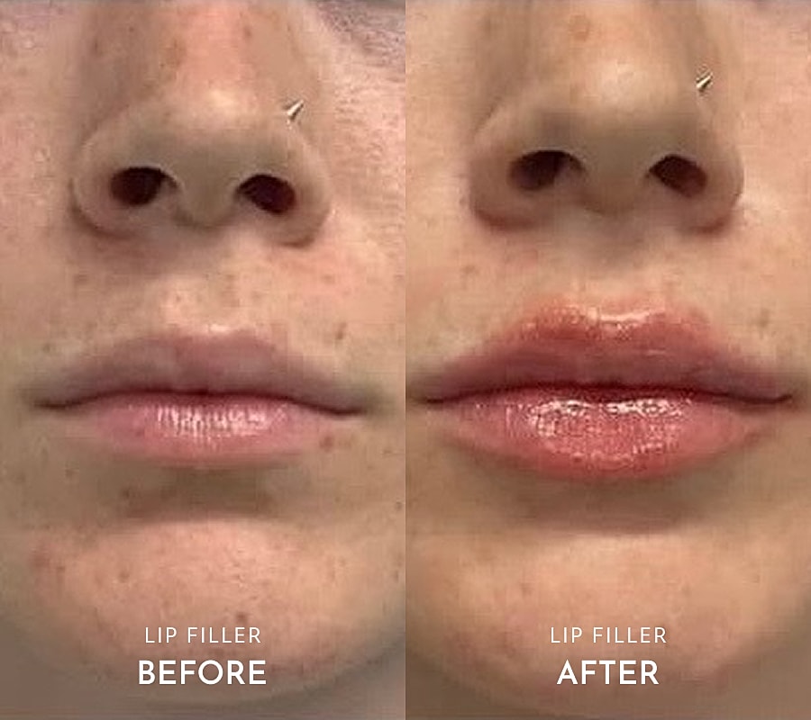 Before and after lip enhancement.