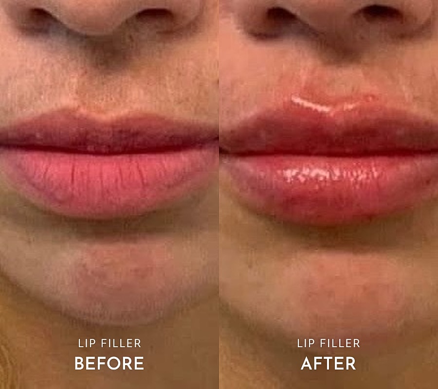 Comparison of natural and enhanced lips.