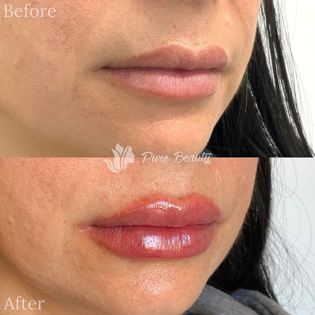 Restylane Before & After
