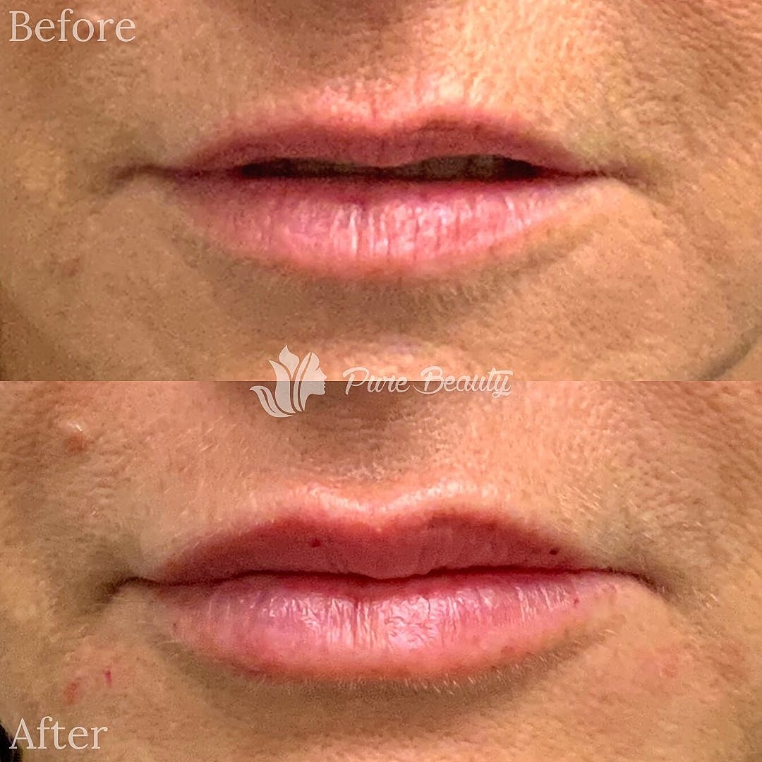 Restylane Before & After