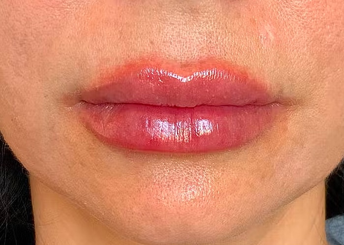 Restylane Before & After