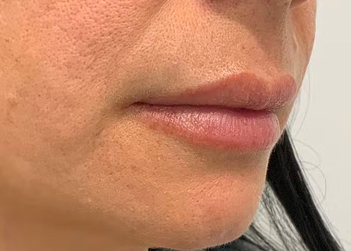 Restylane Before & After