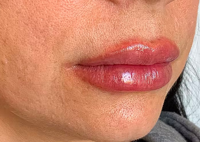 Restylane Before & After