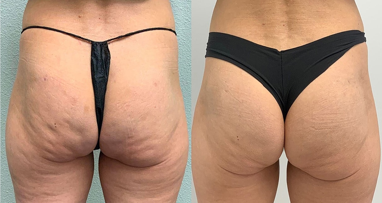Liquid Butt Lift Before & After