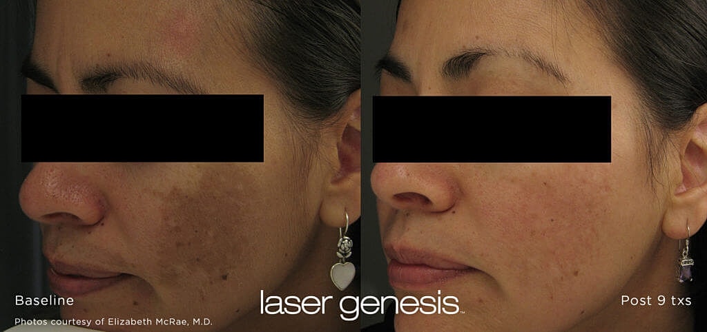 Laser Genesis Before & After