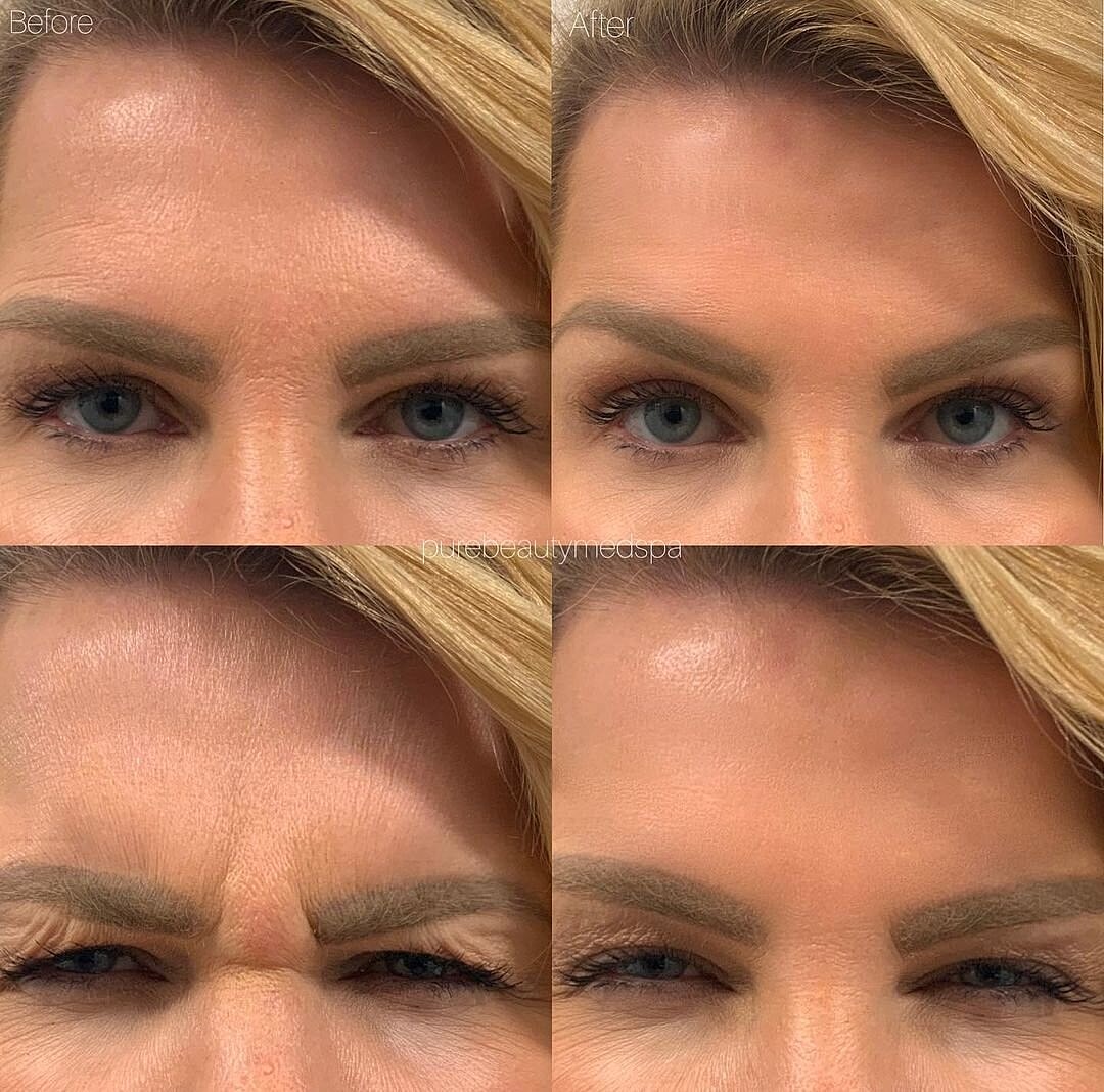 Botox Before & After