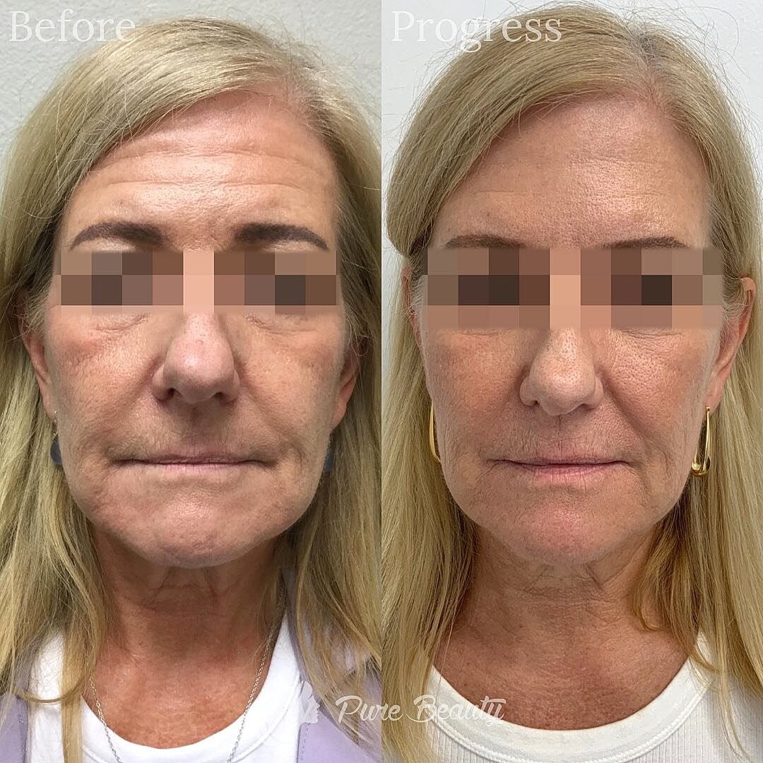 Botox Before & After