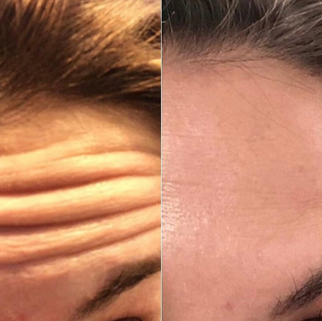 Botox Before & After