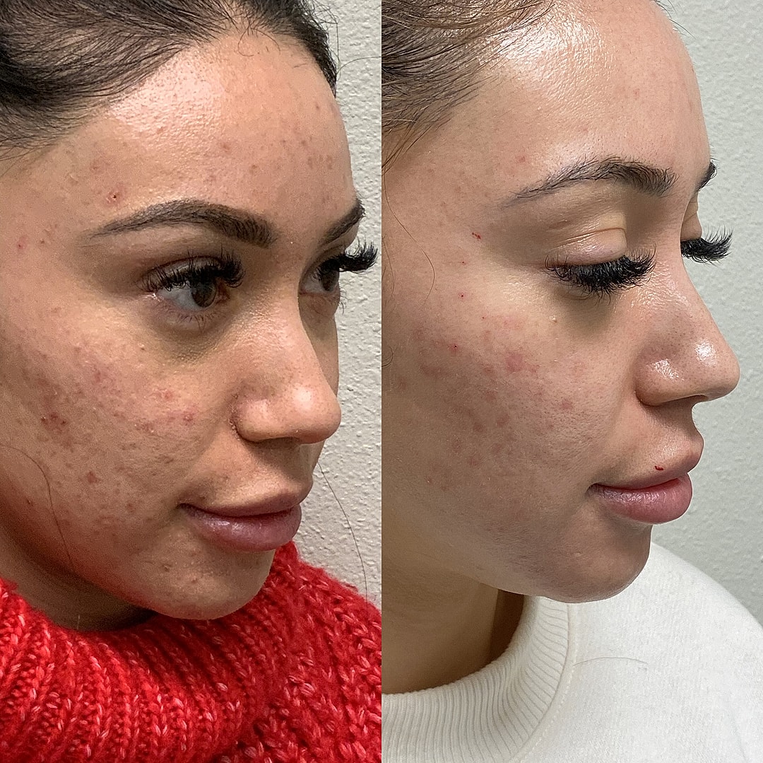 Botox Before & After