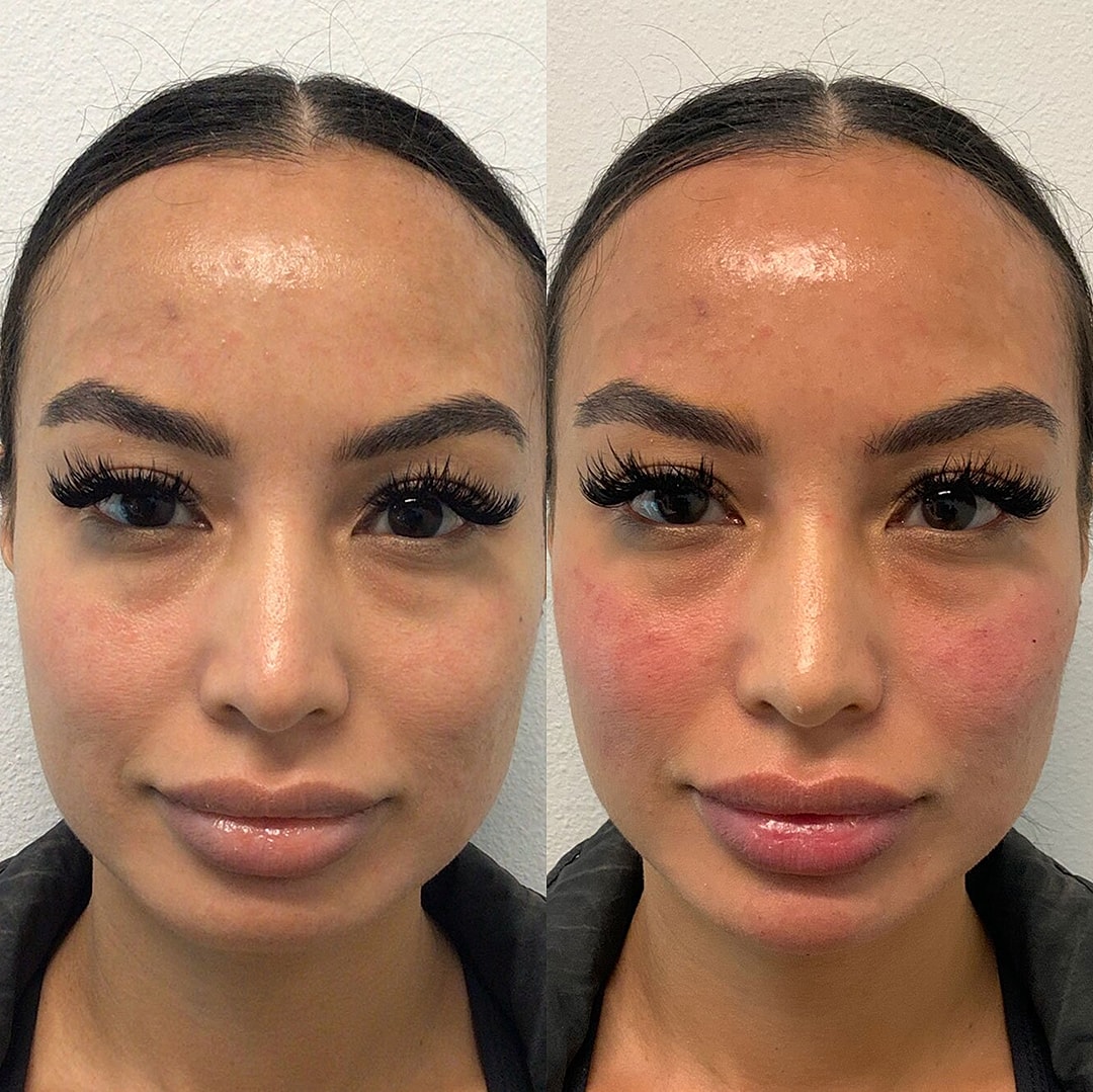 Botox Before & After