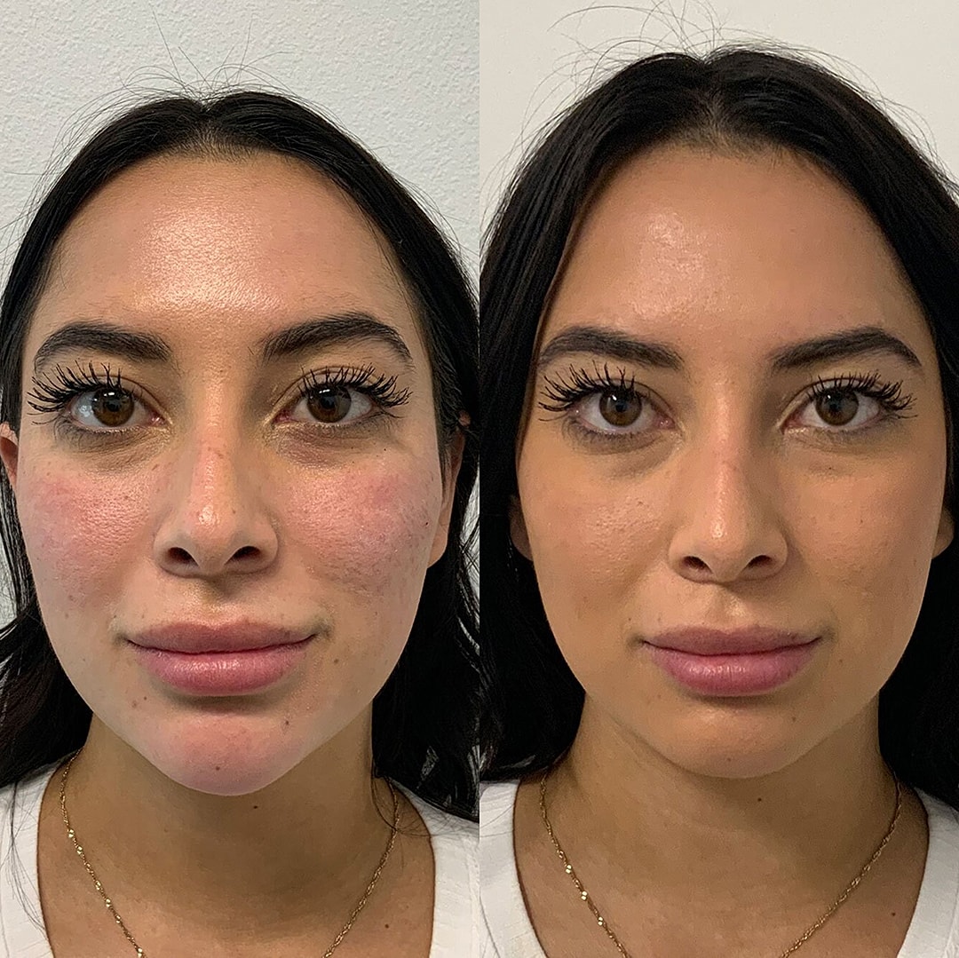 Botox Before & After