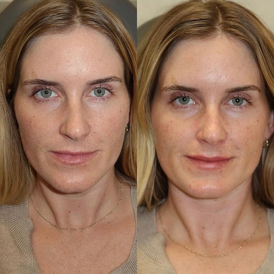 Lip Filler Before & After