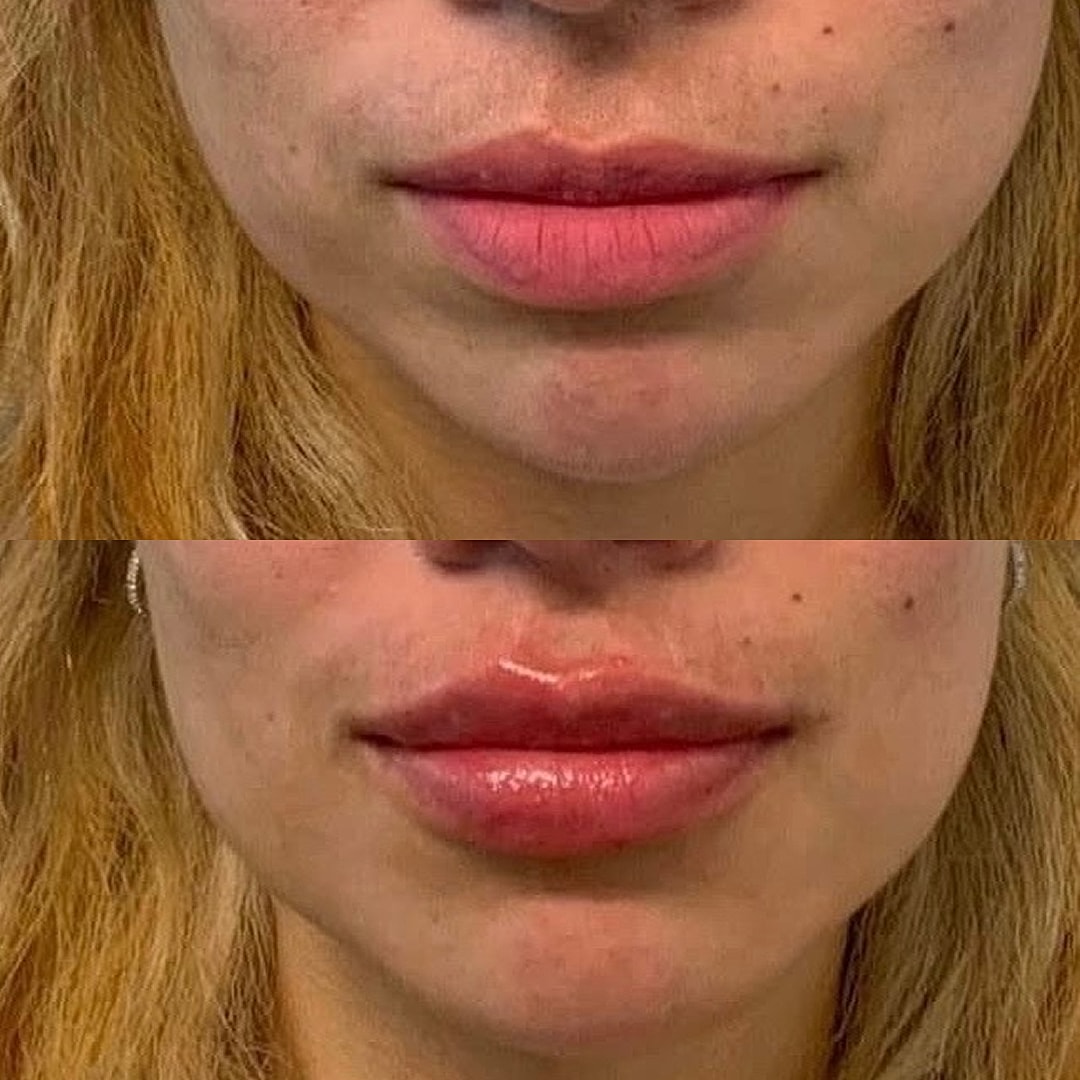 Lip Filler Before & After