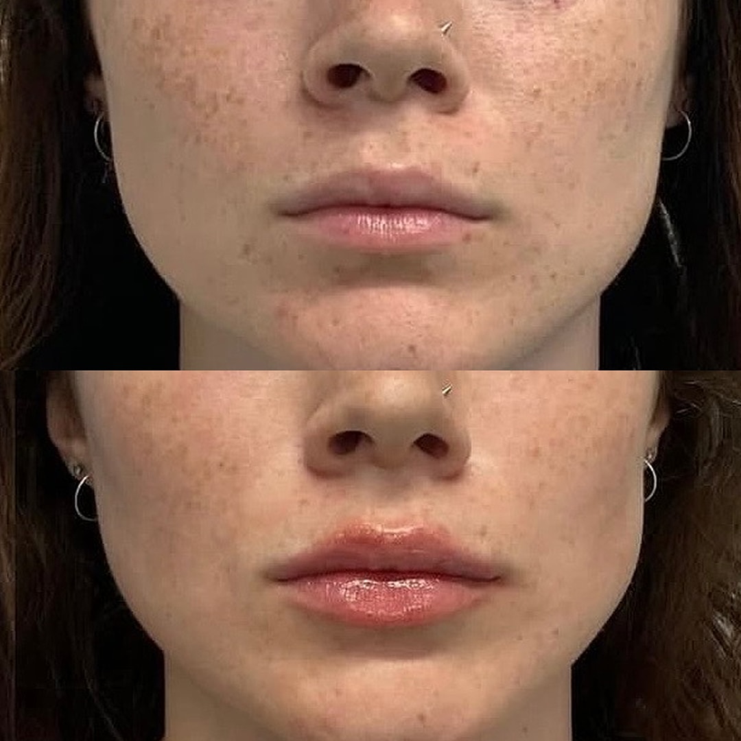 Lip Filler Before & After
