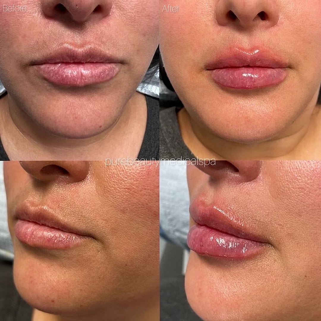 Lip Filler Before & After