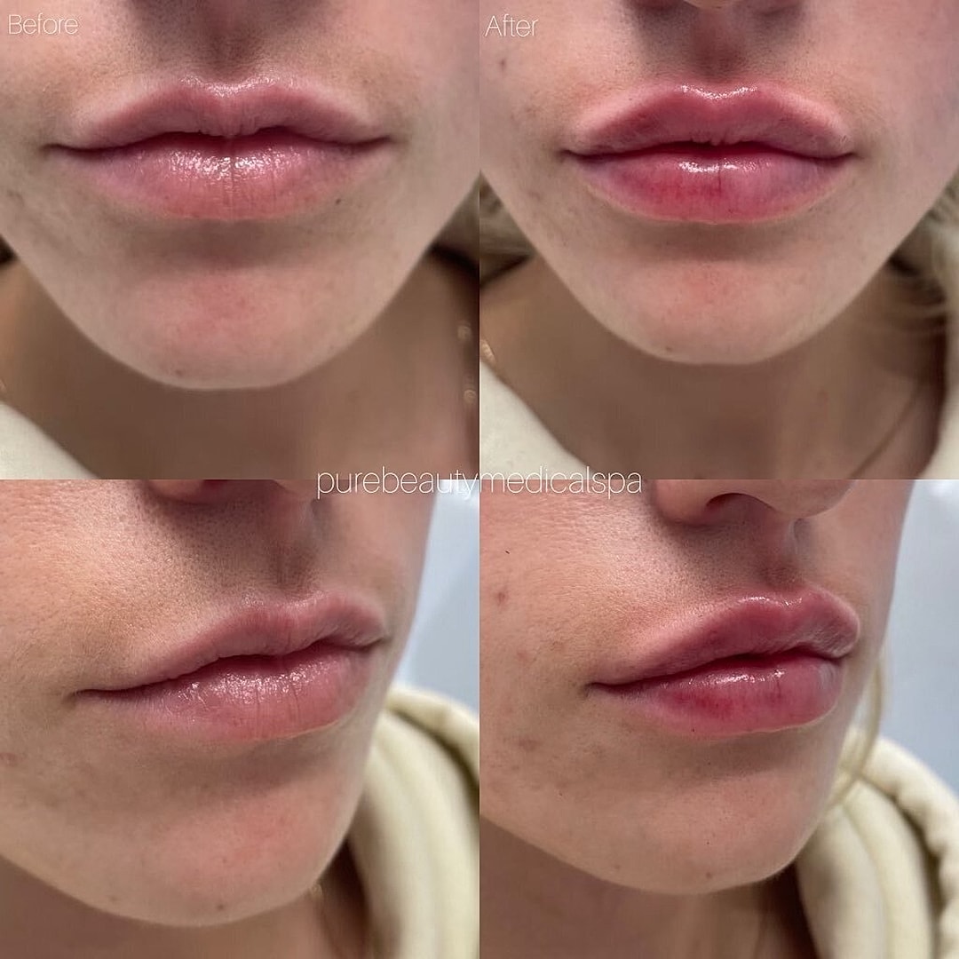 Lip Filler Before & After