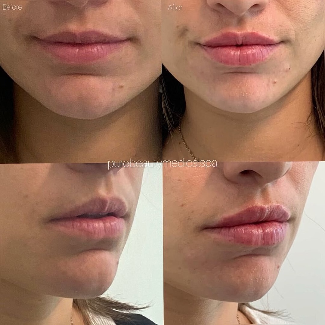 Lip Filler Before & After
