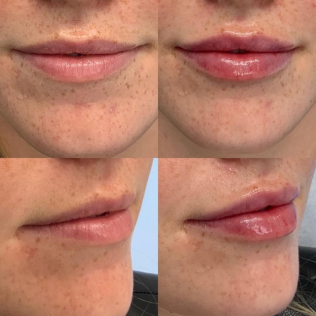 Lip Filler Before & After