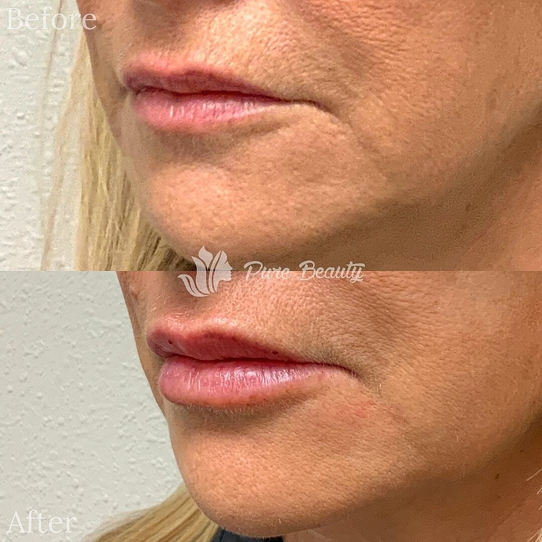 Lip Filler Before & After