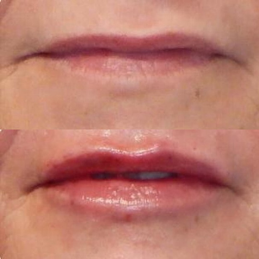 Lip Filler Before & After