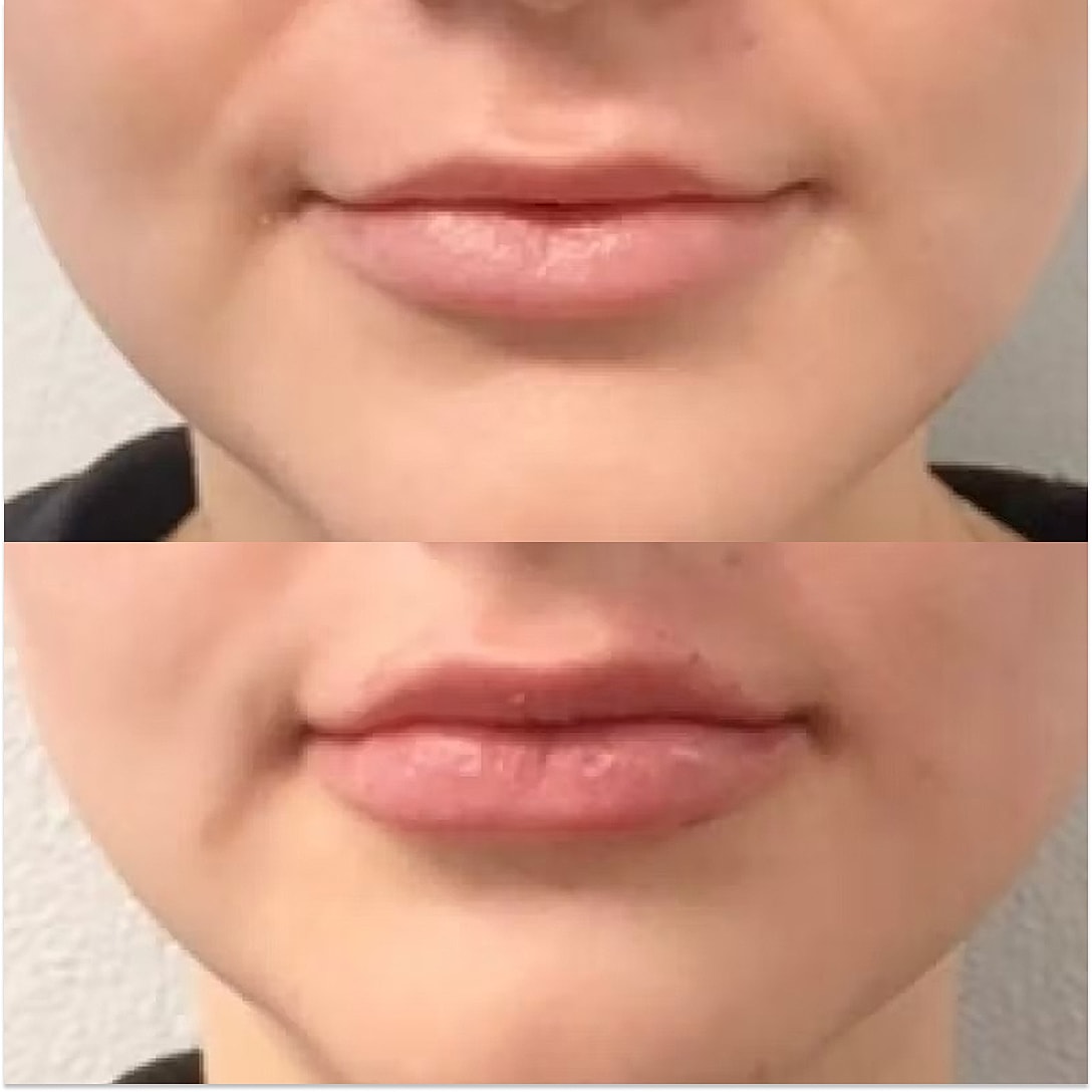 Lip Filler Before & After