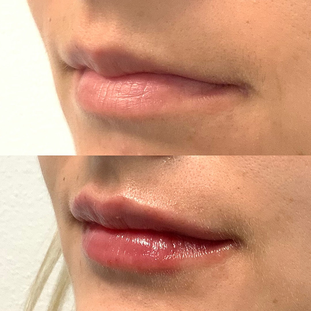 Lip Filler Before & After