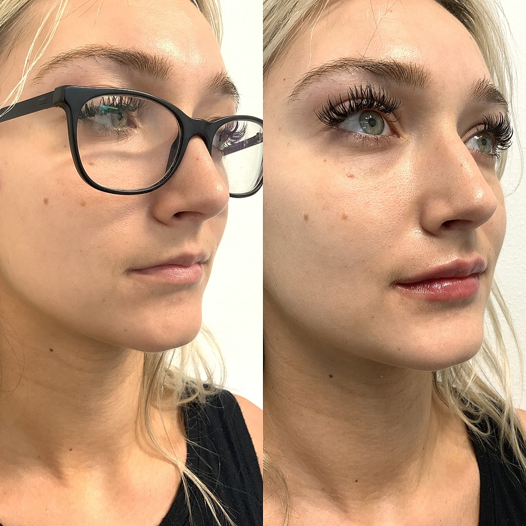Lip Filler Before & After