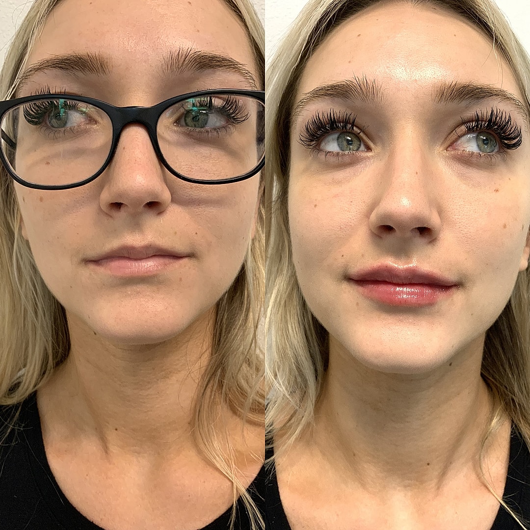 Lip Filler Before & After