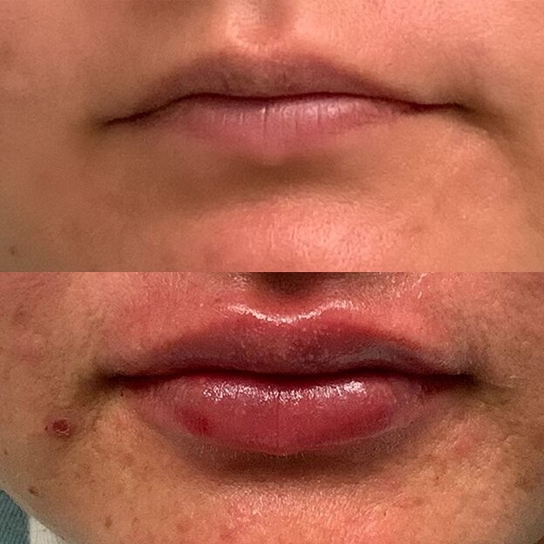 Lip Filler Before & After