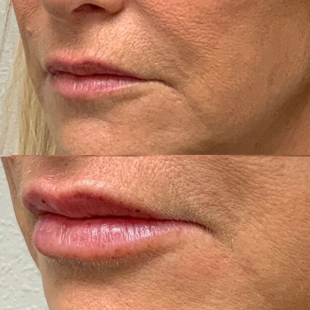Lip Filler Before & After