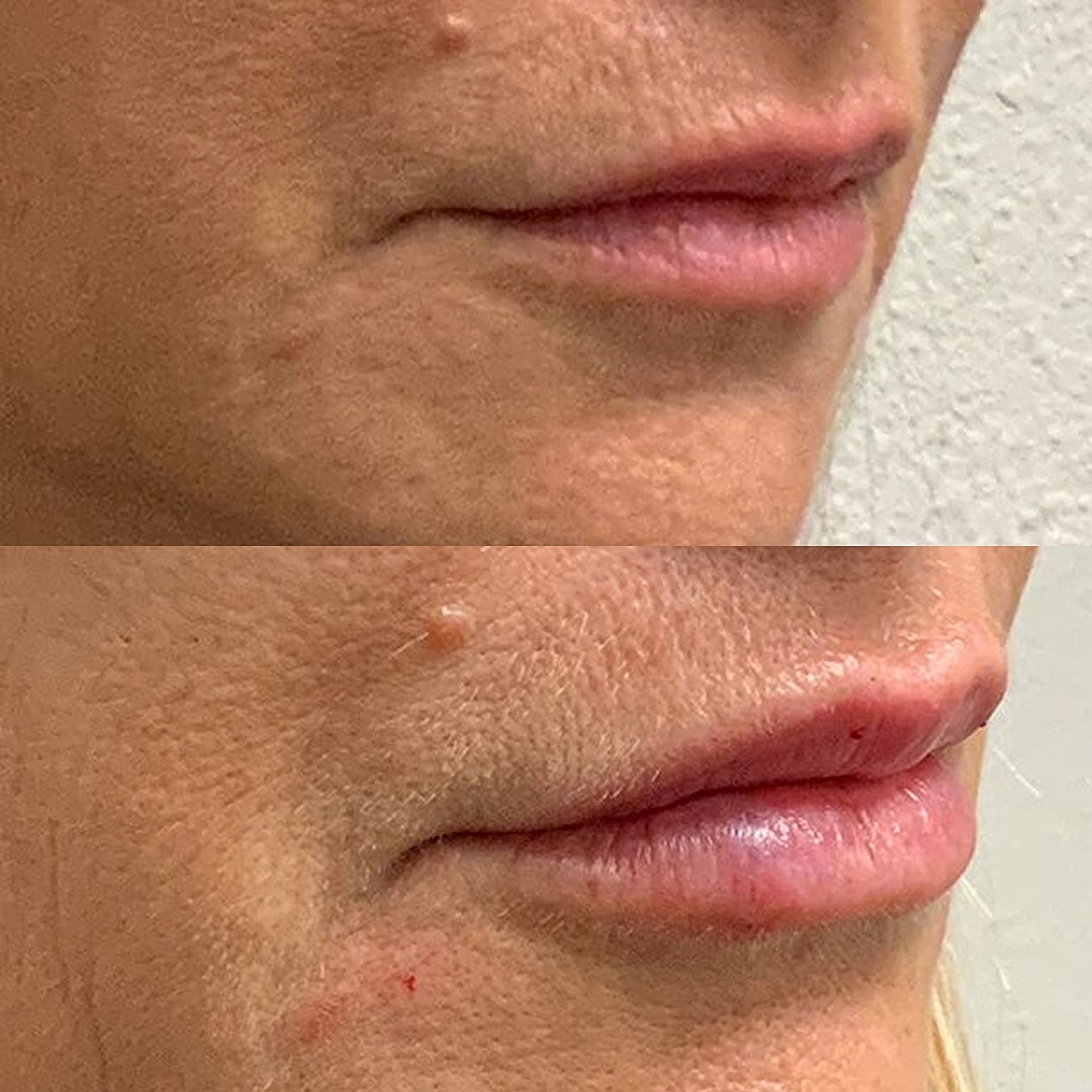 Lip Filler Before & After