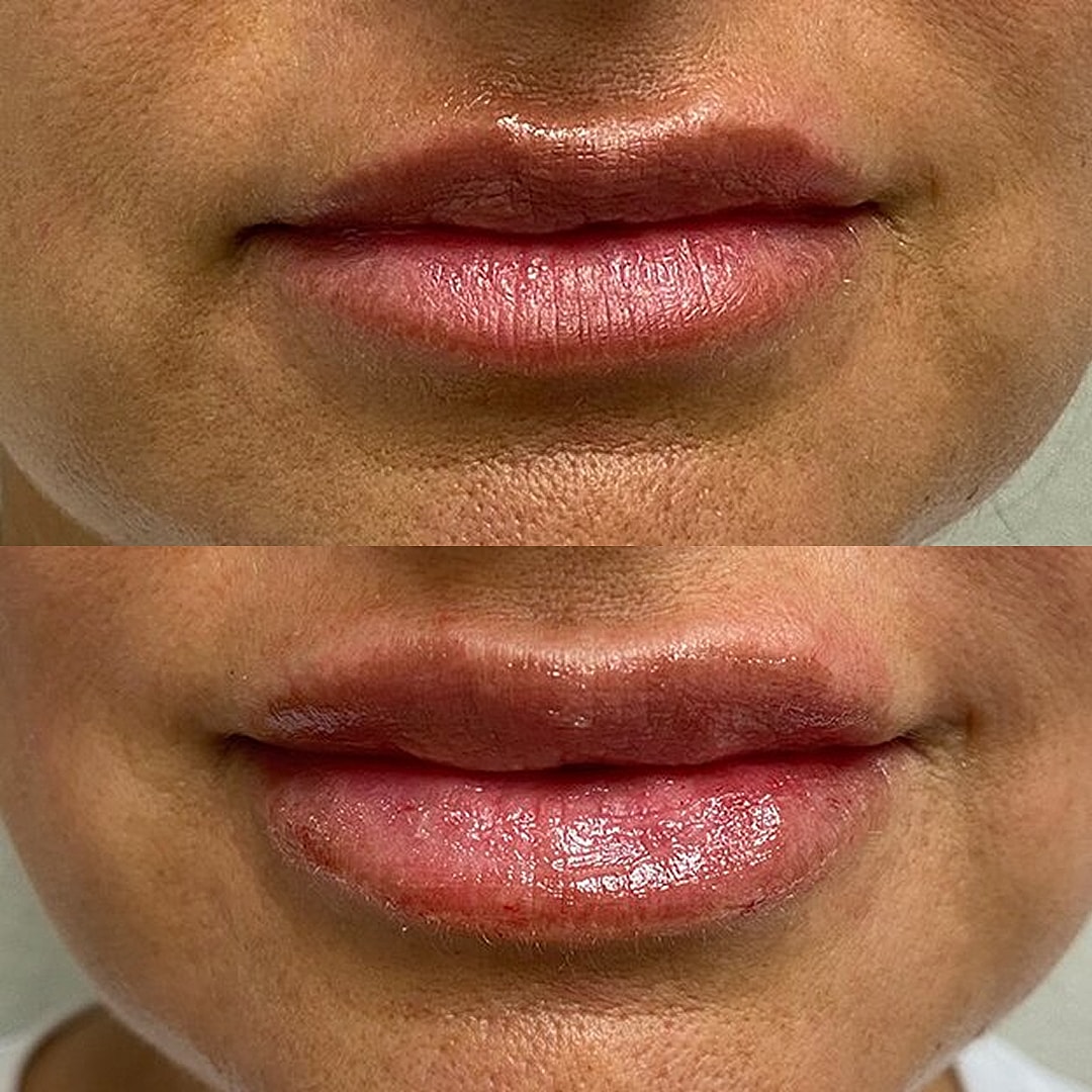 Lip Filler Before & After