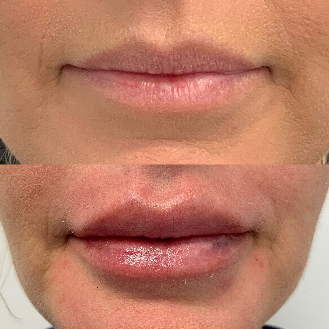 Lip Filler Before & After