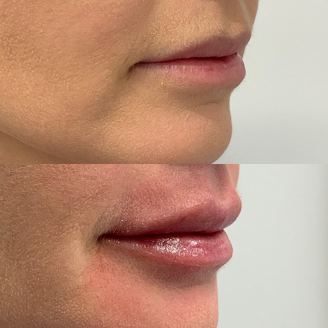 Lip Filler Before & After