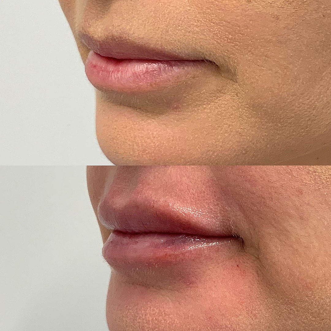 Lip Filler Before & After