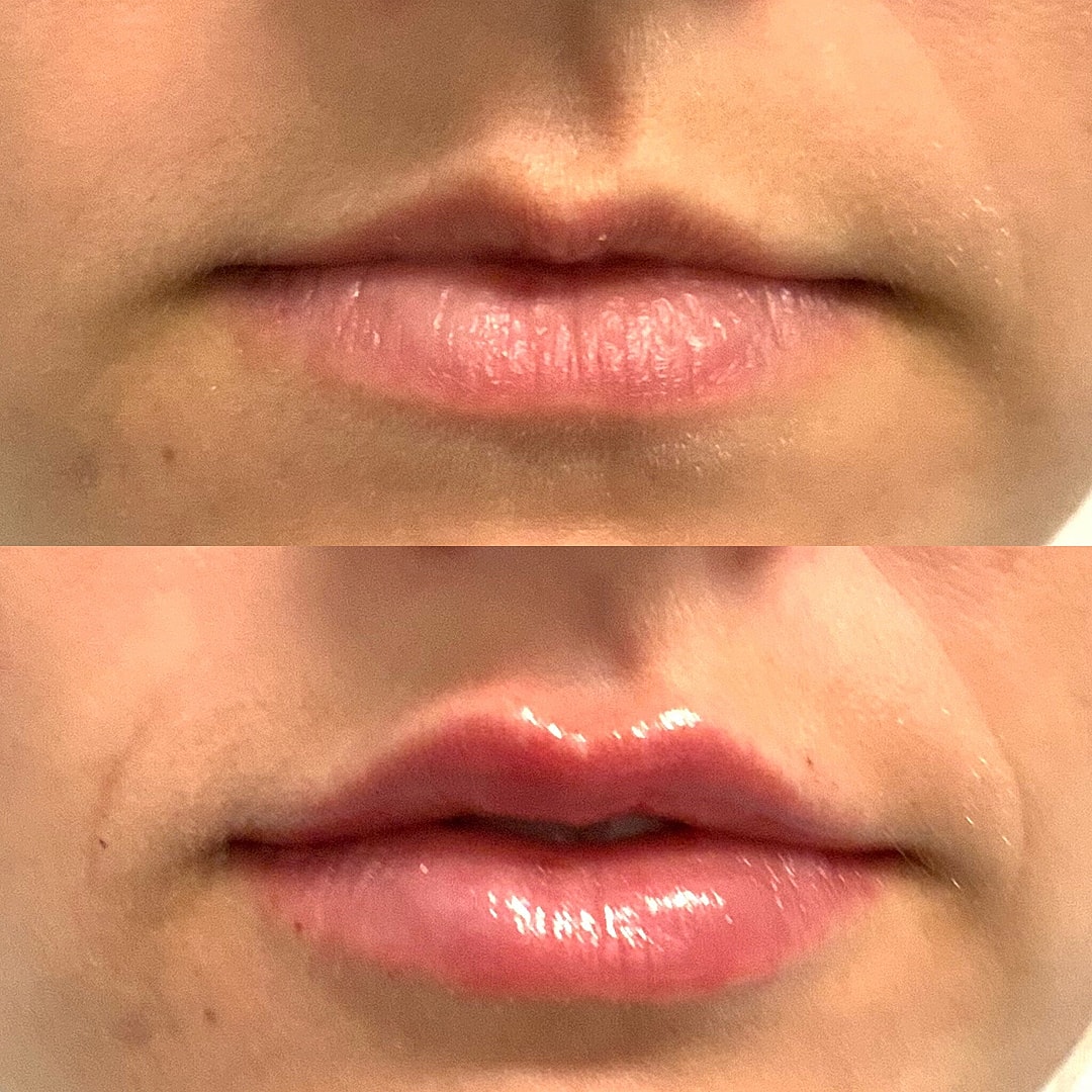 Lip Filler Before & After