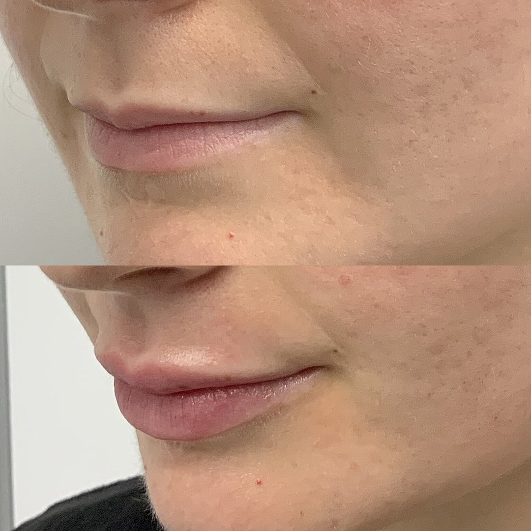 Lip Filler Before & After