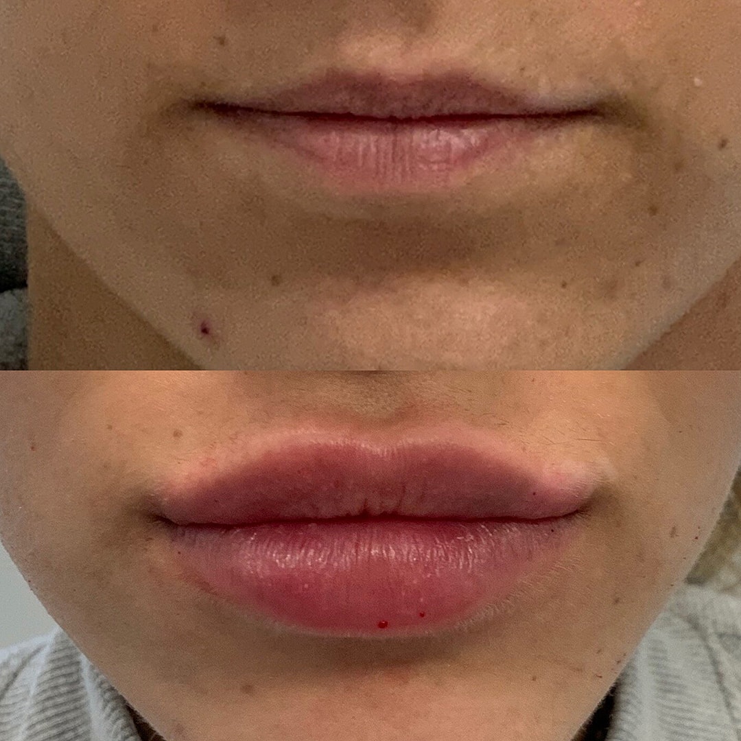 Lip Filler Before & After
