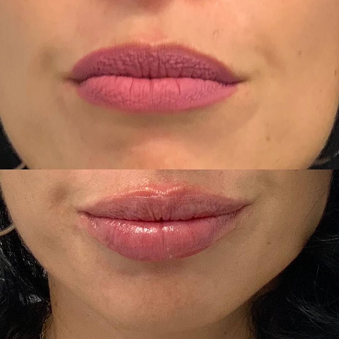 Lip Filler Before & After